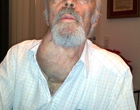 Die Struma ein Überbegriff